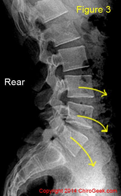 lordosis