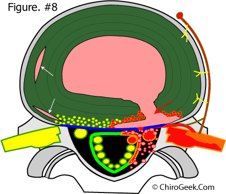 biochemical induced sciatica