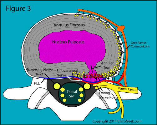 contained disc herniation