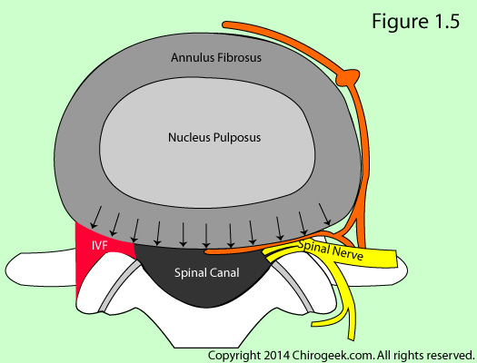 disc bulge