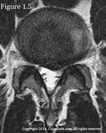 left paracentral herniation