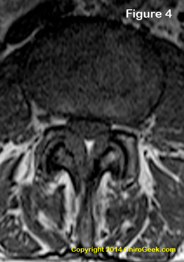 central stenosis